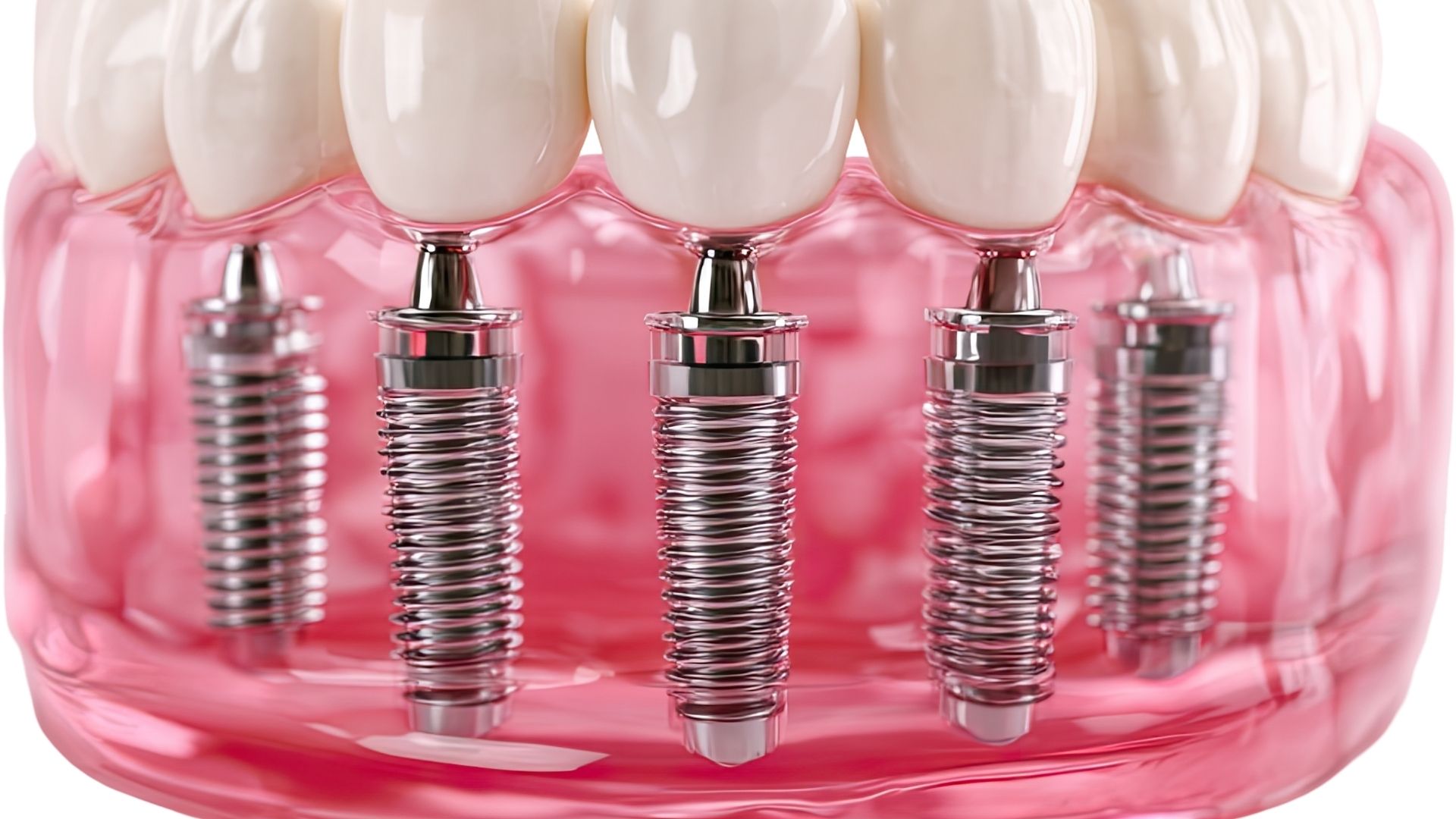 Dental Implants in Alexandria VA — Dura Dental