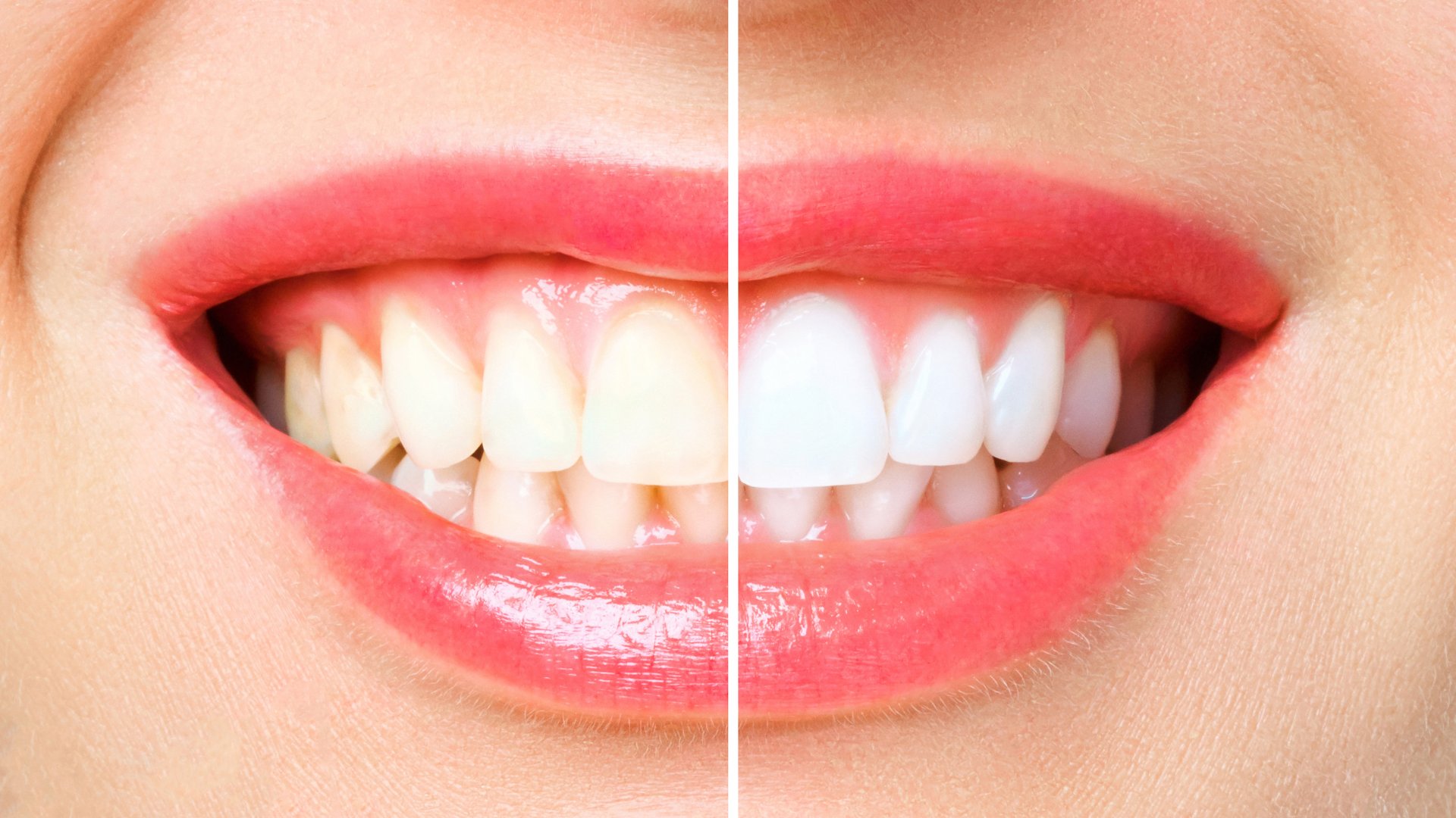 Teeth Whitening in Alexandria VA — Dura Dental